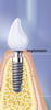 Implantaten
