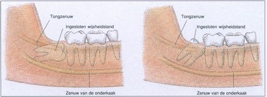 verwijderen ingesloten wijsheidstand